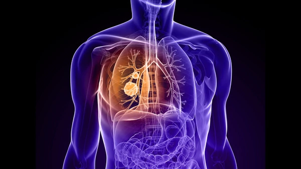 El más mortal de todos: tres vidas por minuto se cobra el cáncer de pulmón