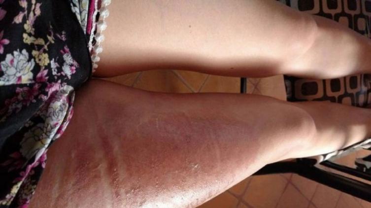 Se quemó casi medio cuerpo con el líquido de la funda de su smartphone