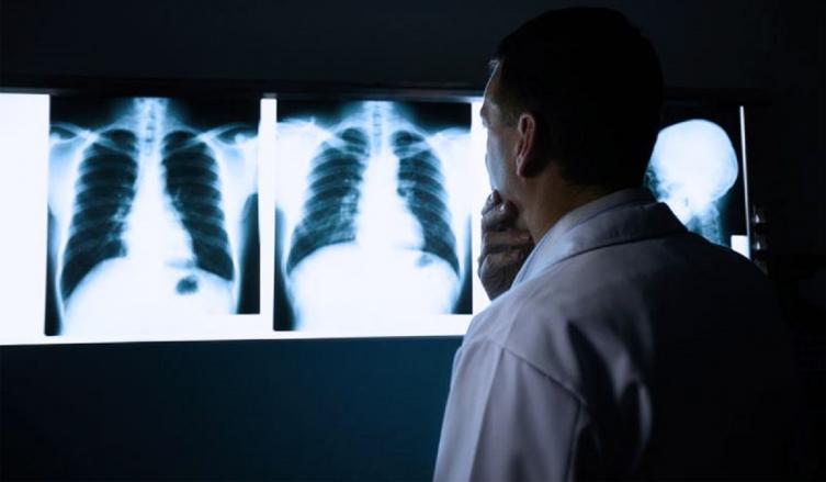 Día mundial de lucha contra la tuberculosis: diferencias entre neumonía y tuberculosis