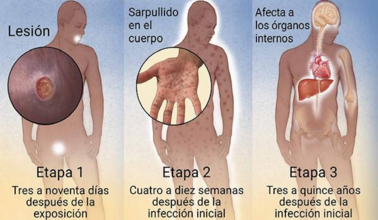 Preocupación por el notable aumento de los casos de sífilis en los últimos años