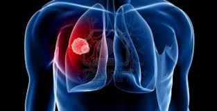 Novedades en el tratamiento de un tipo de cáncer de pulmón