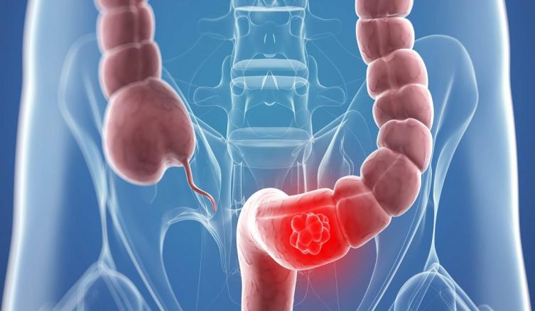 Charla abierta sobre cáncer de colon 
