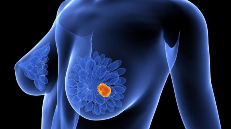 Revolucionario: el nuevo mecanismo contra el cáncer de mama