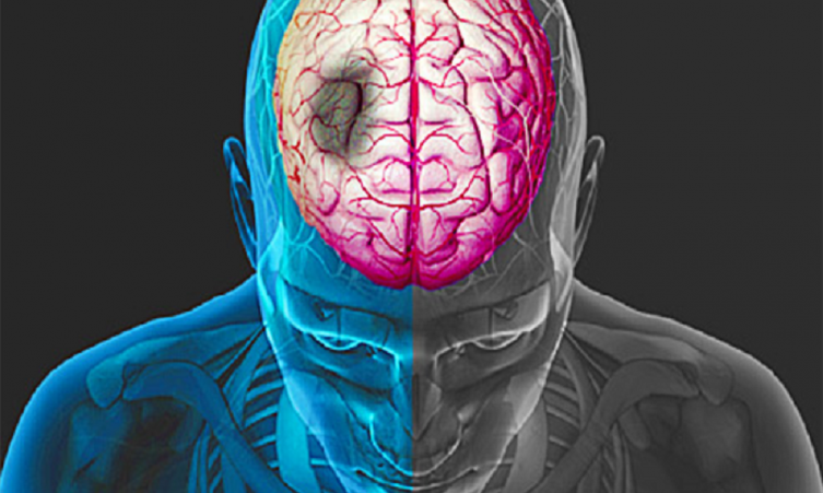 Prevención del accidente cerebro vascular (ACV) 