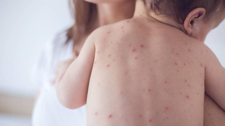 Crece el número de personas con Sarampión en el país