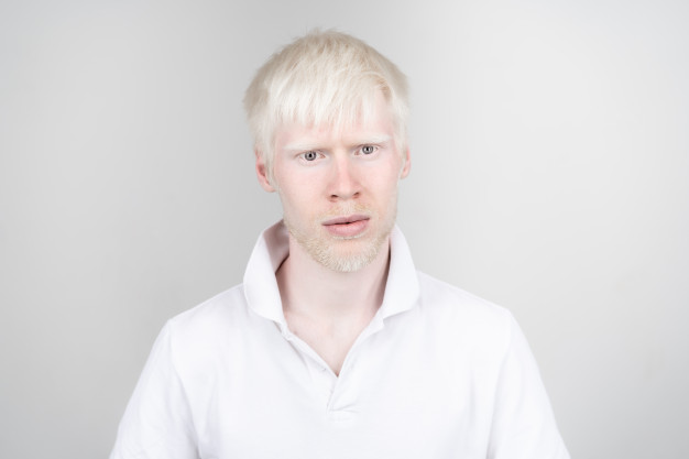 Albinos: entre el sol, los prejuicios y la búsqueda de una mejor calidad de vida