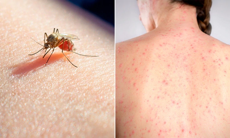 Son 2.942 los casos de dengue y 158 los de sarampión en la Argentina