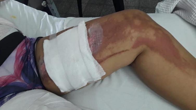 Le tiró una olla de agua hirviendo a su pareja y sigue en libertad