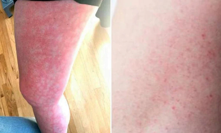 El extraño sarpullido que podría ser un nuevo síntoma de COVID-19