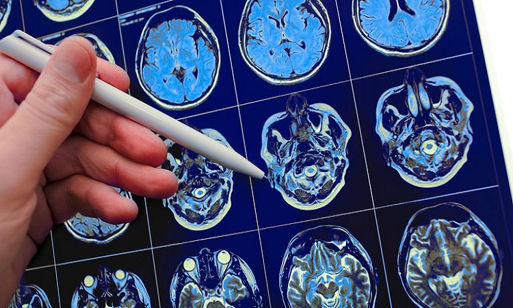 En Argentina se realiza la única cirugía de estimulación cerebral profunda para epilepsia refractaria de toda Latinoamérica