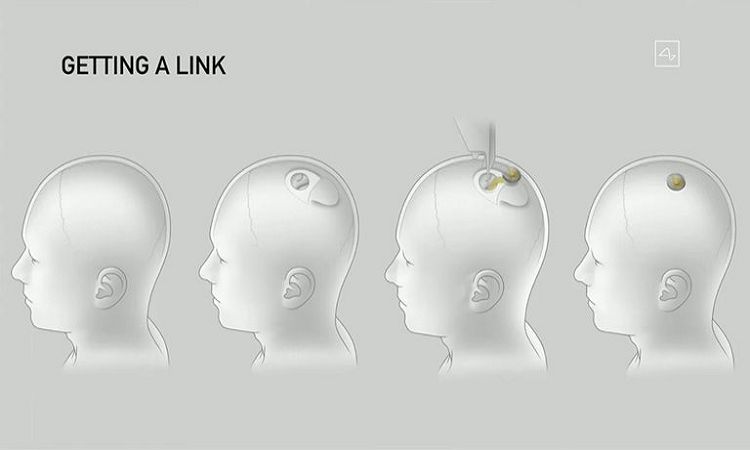 Neuralink: Elon Musk presentó su plan para implantar chips en el cerebro