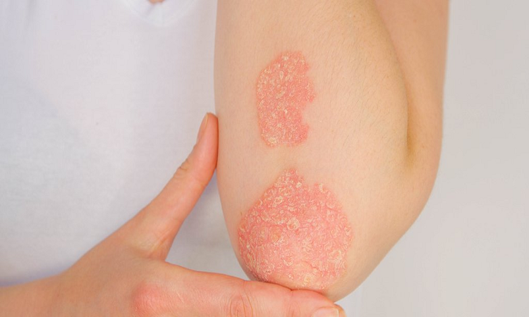 Psoriasis: enfermedad inflamatoria y crónica que no contagia
