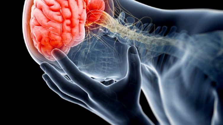 Lo que debes saber sobre el Accidente Cerebrovascular (ACV)