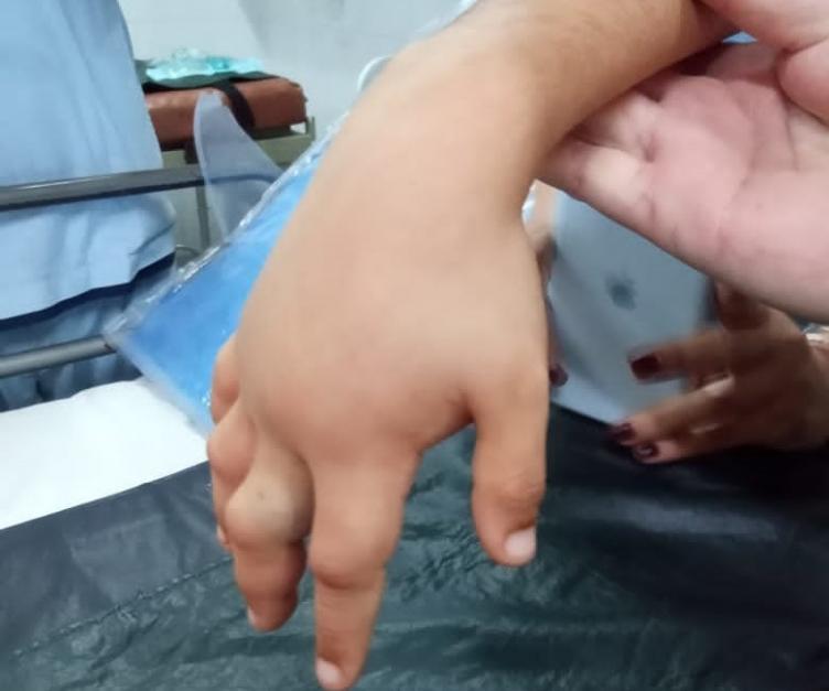 Un niño de siete años fue picado por una Yarará en la Costanera 