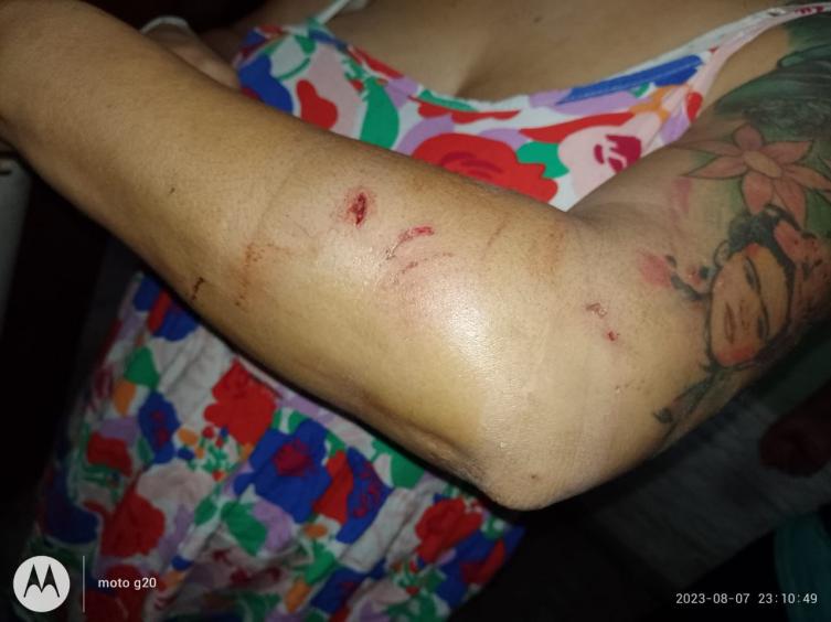 Nuevo ataque pitbull: una mujer fue atacada por dos perros en barrio Loyola Sur