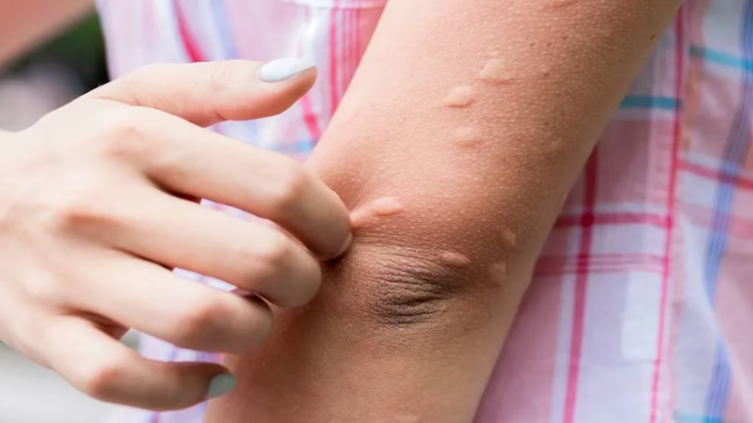 Así diferencias la urticaria crónica de la alergia