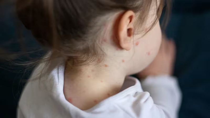 Confirman en Salta un caso de sarampión en un bebé de 19 meses