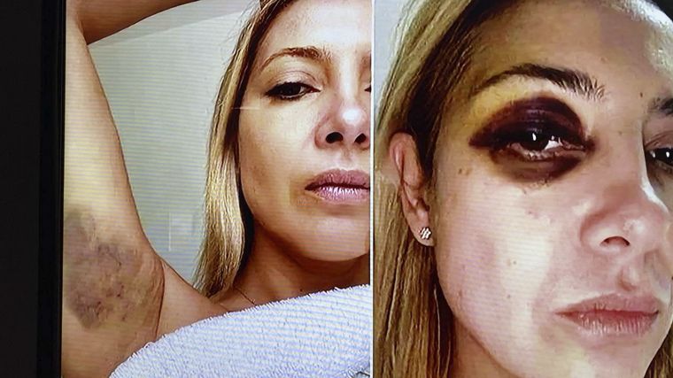 La denuncia contra Alberto Fernández: difunden fotos de Fabiola Yáñez golpeada