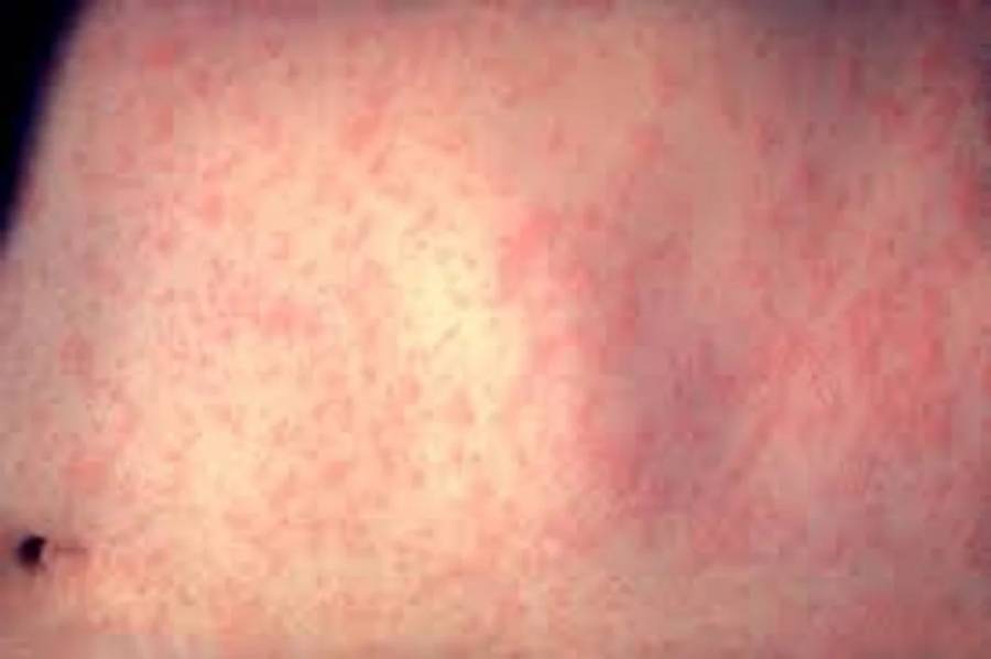 Paraguay confirmó un caso de sarampión tras 10 años de eliminación de circulación del virus