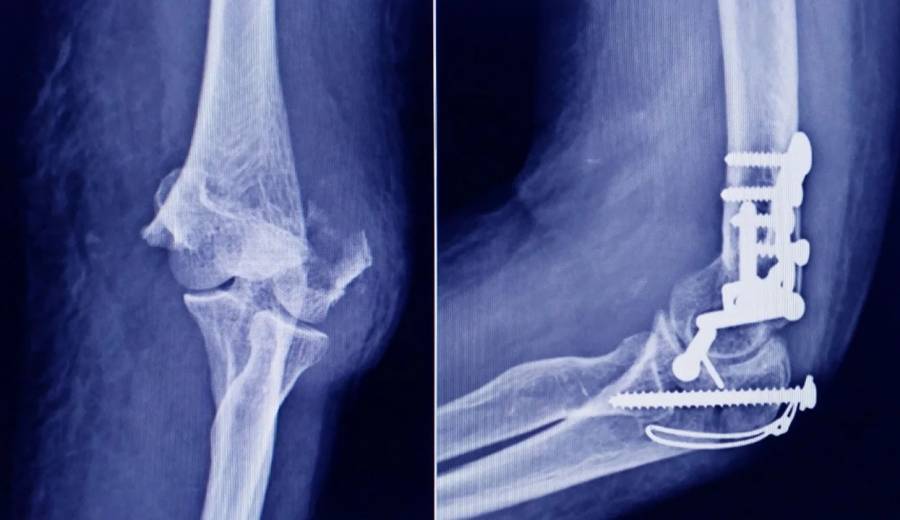 ANMAT advierte que un tornillo utilizado en cirugías traumatológicas es falso