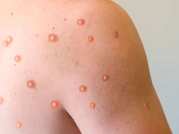 Viruela del mono: detectaron el primer caso en Argentina de la variante más agresiva y contagiosa